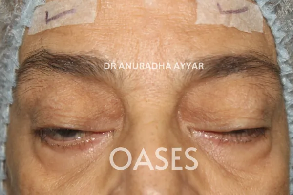 Ptosis Treatment at Oases Eye Care Center