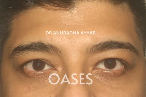 Ptosis Treatment at Oases Eye Care Center