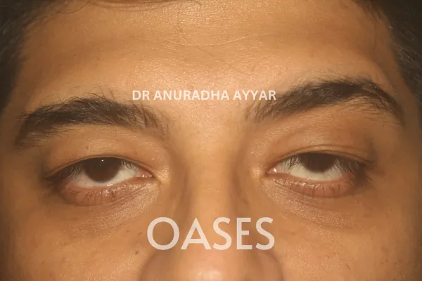 Ptosis Treatment at Oases Eye Care Center