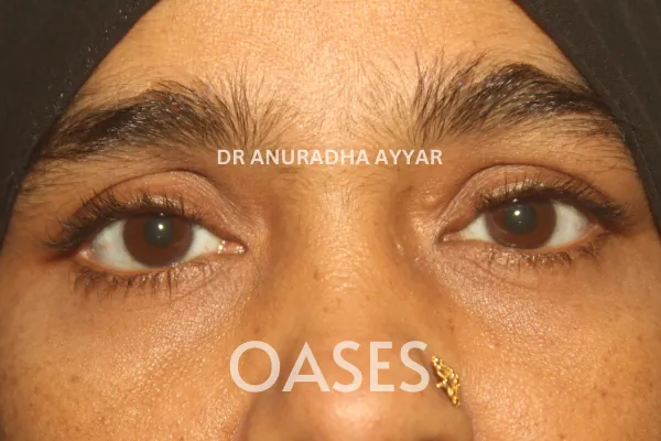 Thyroid Eye Disease Treatment at Oases Eye Care Center