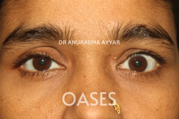 Thyroid Eye Disease Treatment at Oases Eye Care Center