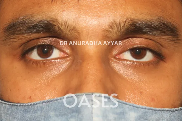 Thyroid Eye Disease Treatment at Oases Eye Care Center