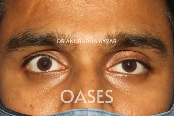 Thyroid Eye Disease Treatment at Oases Eye Care Center