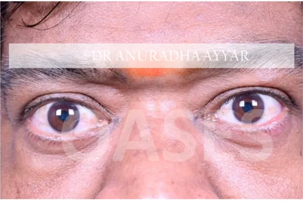 Thyroid Eye Disease Treatment at Oases Eye Care Center