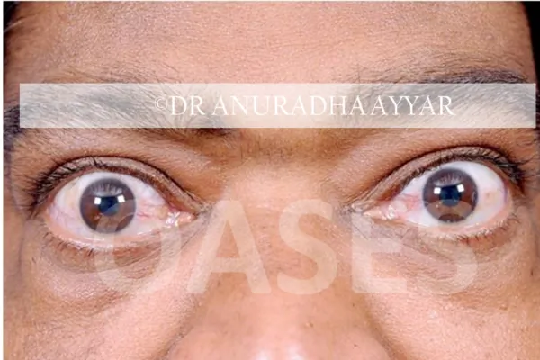 Thyroid Eye Disease Treatment at Oases Eye Care Center