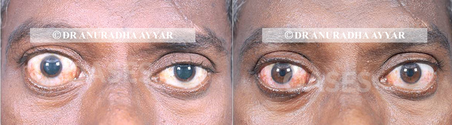 ocular oncology
